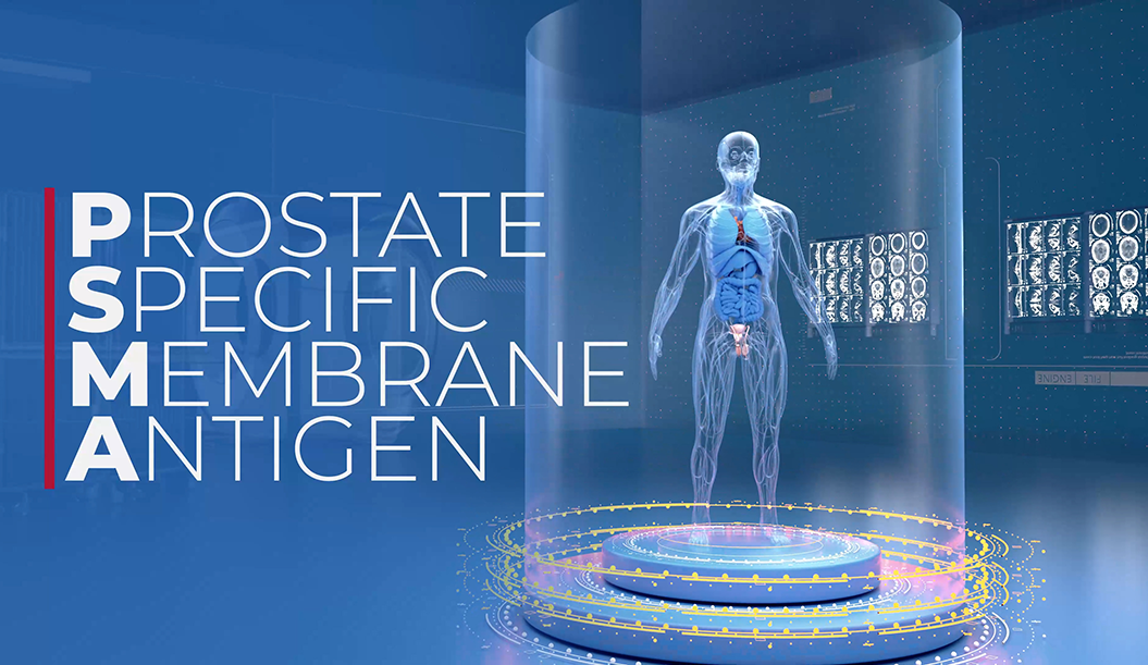 UCBC: PSMA Treatment